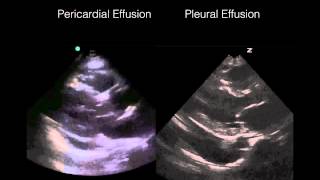 Cardiac Ultrasound Pericardial vs Pleural effusion [upl. by Vonny]