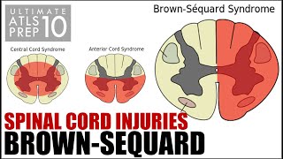 Ultimate ATLS 10 BrownSequard Syndrome  Spine amp Spinal Cord Trauma [upl. by Annawit887]