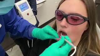 Laser treatment for cold sores and canker sores [upl. by Lizned]