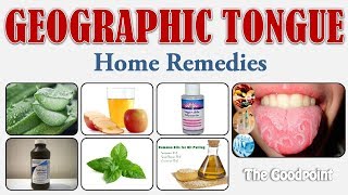 Home Remedies for Geographic Tongue [upl. by Irehc]