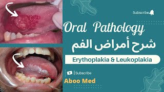 Erythroplakia amp leukoplakia 1 pathology amp systemic diseases related to oral pathology شرح أمراض الفم [upl. by Wynn]