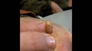 Man Squeezes Botfly from Hand [upl. by Aennyl269]