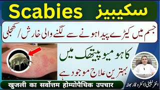 Scabies شدید خارش اور کھجلی शरीर में कीड़ों से खुजली होना Homeopathic Treatment In Urdu  Hindi [upl. by Isaacs]