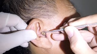 Huge Earwax Removed from GrandPas Ear [upl. by Eatnuahc]