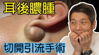 耳後膿腫  發炎粉瘤  膿瘡  皮膚專科  皮膚手術  切開引流術  Epidermoid Cyst  Sebaceous Cyst  Ear Abscess [upl. by Ilse]