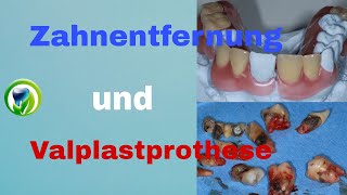 Zahnentfernung und provisorische Prothese Valplastprothese Patientenfall  Zähne ziehen Extraktion [upl. by Oiragelo298]