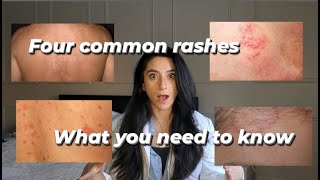 Four common rashes and everything you need to know about them [upl. by Merrell]