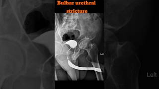 RGU  Retrograde urethrogram  Bulbar urethral stricture shorts rgu radiology specialcase [upl. by Atinahc]