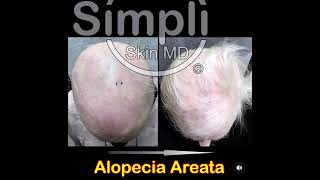 Alopecia Areata [upl. by Hgielrebma]