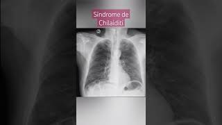 SINDROME DE CHILAIDITI SÍNTOMAS [upl. by Riess677]