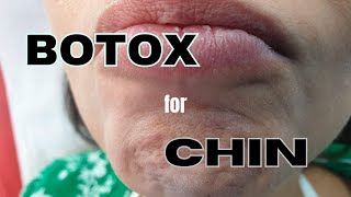 How to inject BOTOX on CHIN muscle Correcting peau dorange deformity with botulinum toxin [upl. by Anidal]