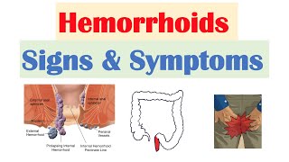 Hemorrhoids Signs amp Symptoms  Internal vs External Hemorrhoid Symptoms  Hemorrhoidal Disease [upl. by Constantina]