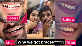 My brace journey CostTimePain suyash [upl. by Oirrad759]