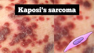 Kaposis sarcoma pathology  Kaposis sarcoma lecture  Quick revision  tarangacademy7561 [upl. by Shelburne]