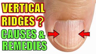 Do You Have Vertical Ridges On Your Nails  Causes amp Natural Cures [upl. by Baillieu]