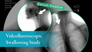 Barium Swallow Barium Esophagram AnteriorPosterior View [upl. by Tory194]