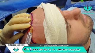 DHI Hair Transplant Stages Turkey 01  Choi Implanter Pen Technique DHI Hair Transplant Videos [upl. by Ardolino]