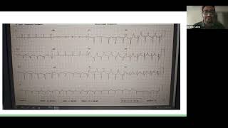 04 07 2024 Case Presentation Cirrhotic Patient for Right Hepatectomy [upl. by Wester]