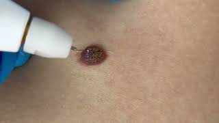 Removing Moles with Plaxel Plasma Pen Amazing Results [upl. by Nomyt646]