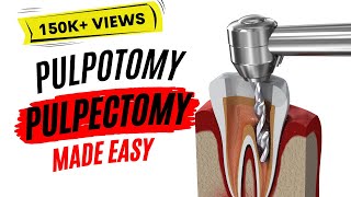 Pulpotomy and Pulpectomy  PEDIATRIC DENTISTRY [upl. by Llerrud]