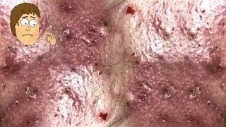 Pretty Removal Blackheads On The Face Easy  How To Remove Blackheads Easy [upl. by Nollek]