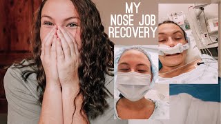 i got a nose job my recovery from septoplasty amp turbinoplasty ROUGH [upl. by Susy]