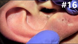 BLACKHEADS EXTRACTIONS on Happy 16 [upl. by Tice682]