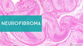 Neurofibroma Neurofibromatosis1 and Low Grade MPNST [upl. by Inalak]