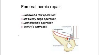 Lockwoods Infrainguinal Approach Surgery for Femoral Hernia Repair [upl. by Notniuqal]