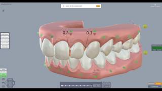 ArchForm Tutorial  How to Plan IPR in the Treatment Planning Software [upl. by Eddie]