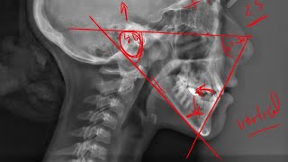 12 Tweed triangle Cephalometric analysis [upl. by Hans491]