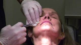 Injection of Botulinum Toxin for Treatment of Perioral Rhytids by Dr Z Paul Lorenc [upl. by Dust]