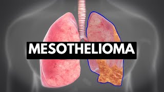 MESOTHELIOMA Causes Signs and Symptoms Diagnosis and Treatment [upl. by Bueschel]