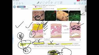 EPIDERMOLYSIS BULLOSA SIMPLEX [upl. by Collins106]