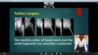 Anteromedial Reduction amp Stabilization of Unstable Trochanteric Fracture Dr Wasudeo Gadegone [upl. by Honan308]