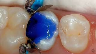 Biomimetic  Immediate Dentin Sealing  بروتوكول البوندنك [upl. by Ailliw]