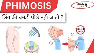 Phimosis causes symptoms and treatment in hindi [upl. by Khai]