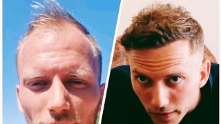 1 Year Hair Transplant Timeline  Day 0 to 365 [upl. by Assirec443]