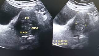 Subserosal fibroid [upl. by Manley]