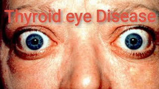 Orbit  Thyroid Eye Disease Graves ophthalmopathy  Part 4 [upl. by Donata]