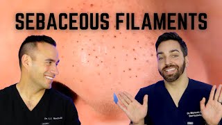 Black Dots on the Nose Heres How To Treat Sebaceous Filaments [upl. by Nnaeiluj259]