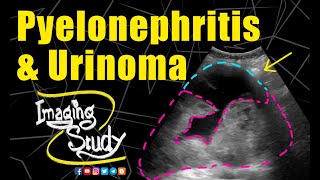 Pyelonephritis with Urinoma  Ultrasound  Case 234 [upl. by Atima]