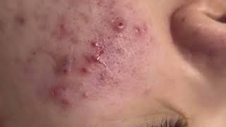 acne acnetreatment relexingvideo relaxing acneremoval relexingvideo relaxing acneremoval [upl. by Elmajian]