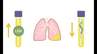 Differentiating transudative and exudative effusions transudate vs exudate [upl. by Nata]