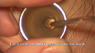 Ear Wax Extraction  St Pauls Hospital [upl. by Cuttie788]