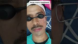 Acne scars treatment I laser for acne scars I TCA for scars  fractional CO2 laser [upl. by Cleodel]