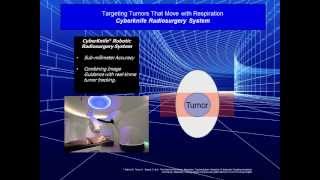 Moving Tumor Targeting Methods Outlined  CyberKnife vs Gating and Breathholds  IMRTIGRT [upl. by Macey601]