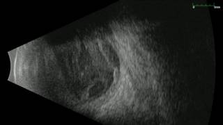 Ophthalmic Edge  Typical Endophthalmitis Case Seen by Ultrasound [upl. by Yecaw]