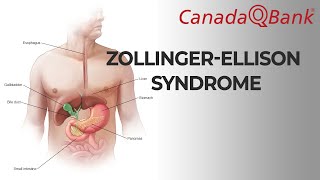 ZollingerEllison syndrome [upl. by Graham]