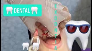 Extraction of maxillary first premolar for orthodontic treatment🦷🦷🦷🦷 Maxillary Exodontia techniques [upl. by Galer]